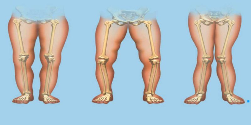 Rickets - Diabetologist Endocrinologist Kefalas Nikolaos - Athens