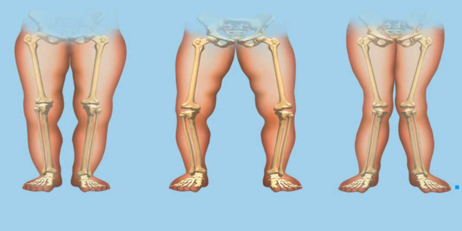 Rickets - Diabetologist Endocrinologist Kefalas Nikolaos - Athens